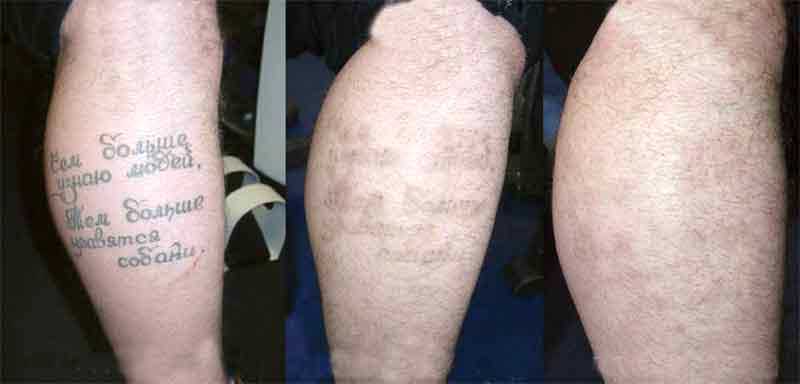 Остаются ли шрамы после лазерного удаления тату?